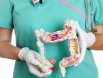 Ung thư đại tràng giai đoạn 2: Sống được bao lâu? Có chữa được không?